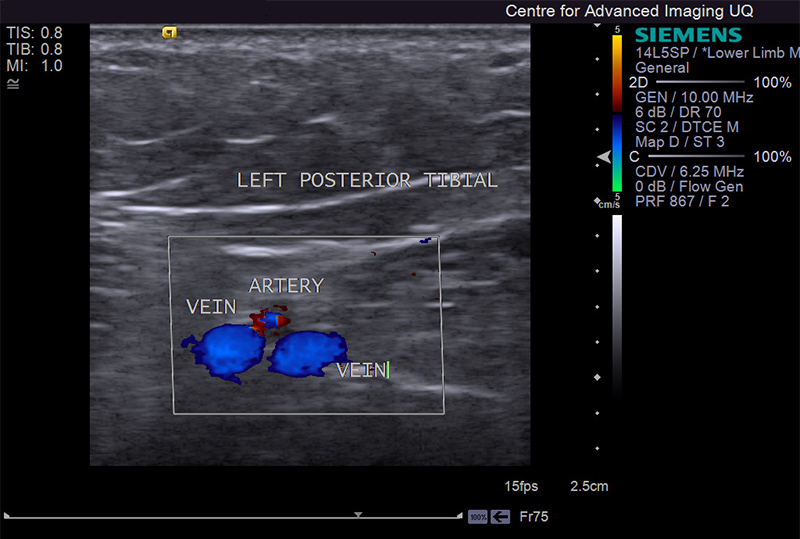 ultrasound image of artery and vein